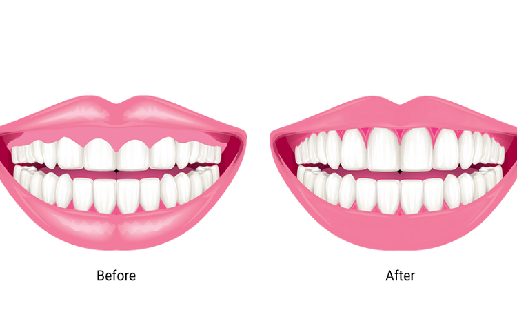 Familiarity with gum lift or contouring | The best dentist in Isfahan
