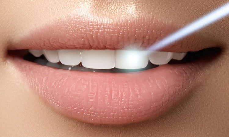 Bleaching or whitening teeth with laser | The best cosmetic dentist in Isfahan
