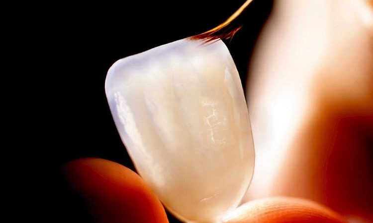 Placement du stratifié sur la dent | Le meilleur implant à Ispahan
