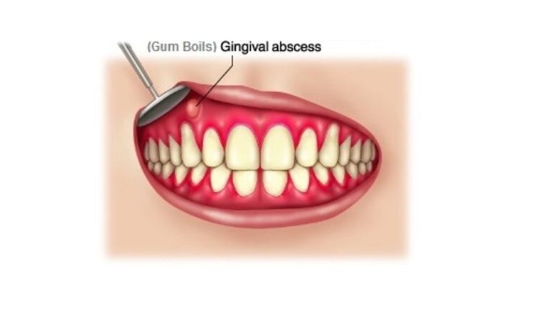 Ways to treat all types of gum acne | The best dentist in Isfahan