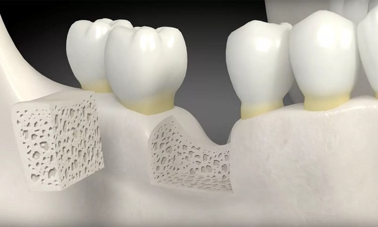 Different methods of bone grafting | The best implant in Isfahan