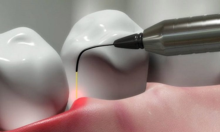 Different methods of gum surgery | The best cosmetic dentist in Isfahan