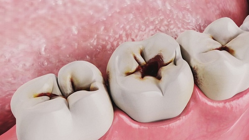 راه های ترمیم و درمان دندان پوسیده | بهترین جراح لثه اصفهان