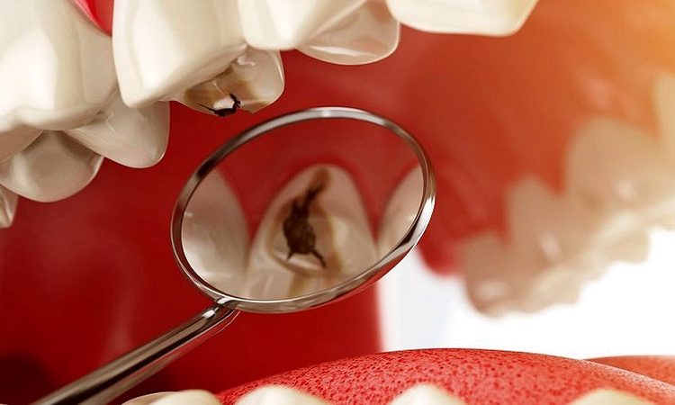 Méthodes de prévention de tous les types de carie dentaire | Le meilleur implant à Ispahan