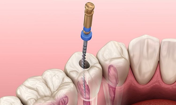 Frequently asked questions about denervation and endodontic treatment | The best cosmetic dentist in Isfahan