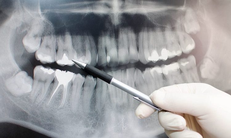 علل انجام رادیولوژی دهان و دندان | بهترین دندانپزشک زیبایی اصفهان