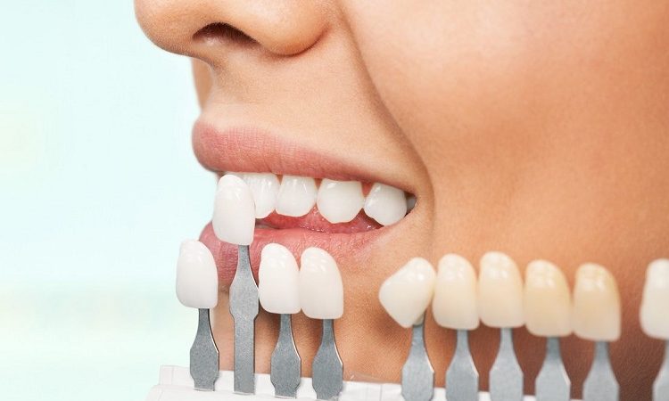 Reasons for restoration and removal of dental laminate | The best dentist in Isfahan