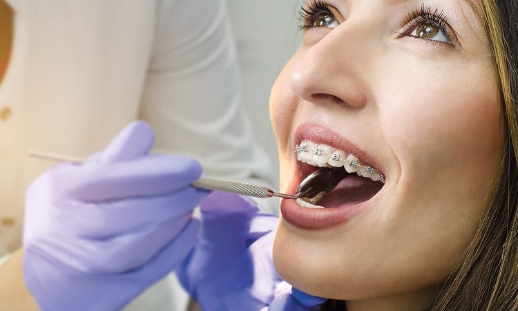 Facteurs influant sur la durée du traitement orthodontique | Le meilleur dentiste cosmétique à Ispahan