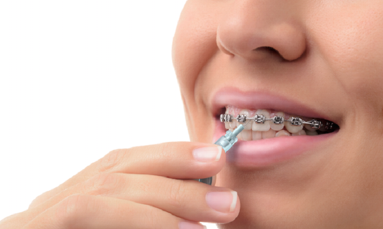 Care during orthodontics | The best dentist in Isfahan