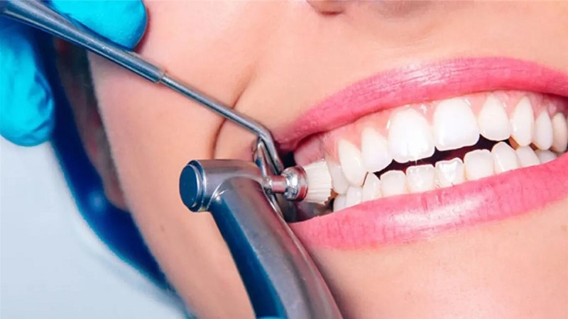 نکاتی برای قبل از جرمگیری و بروساژ دندان | بهترین دندانپزشک زیبایی اصفهان
