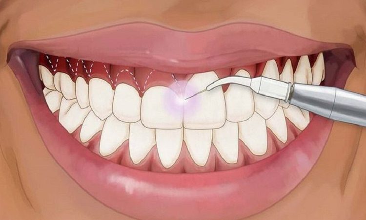 پاسخ به سوالات متداول پیرامون لیفت لثه | Le meilleur dentiste d'Ispahan