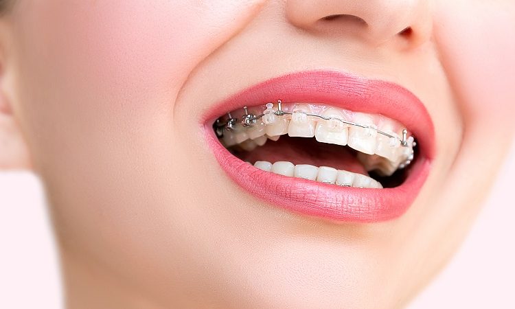 Frequently asked questions about orthodontics | The best cosmetic dentist in Isfahan