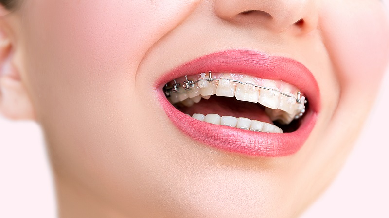 پرسش های متداول در مورد ارتودنسی | بهترین دندانپزشک زیبایی اصفهان