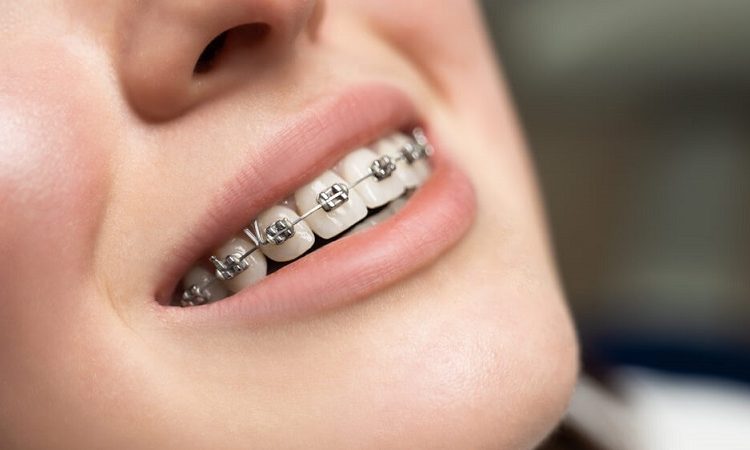 Frequently asked questions about dental orthodontics | The best gum surgeon in Isfahan