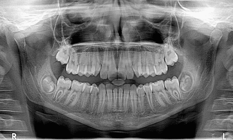 Types d'images radiographiques de la bouche | Le meilleur chirurgien des gencives à Ispahan