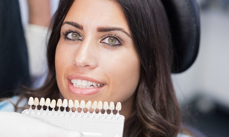 Different types of dental veneers | The best implant in Isfahan