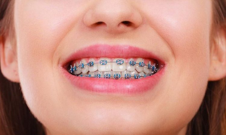 Checking the types of fixed orthodontic brackets | The best implant in Isfahan