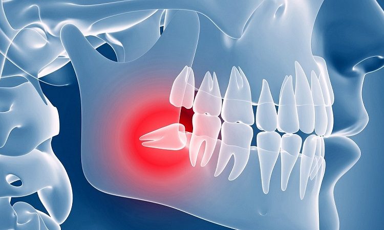 Wisdom tooth surgery | The best implant in Isfahan