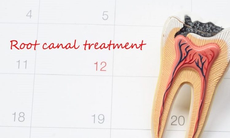 زمان ضرورت به عصب کشی دندان | Le meilleur chirurgien des gencives à Ispahan