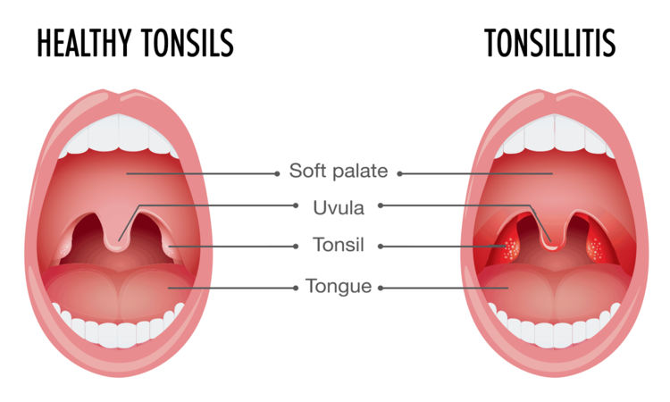 Causes of tonsil stone formation | The best dentist in Isfahan