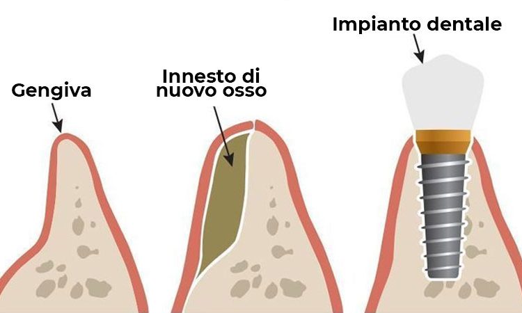 Read before jaw bone grafting for dental implants | The best dentist in Isfahan