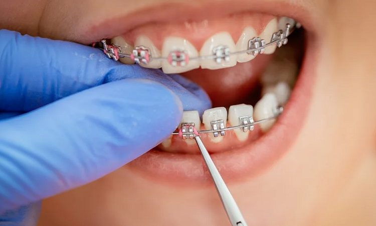 إجراءات تقويم الأسنان | افضل دكتور اسنان في اصفهان