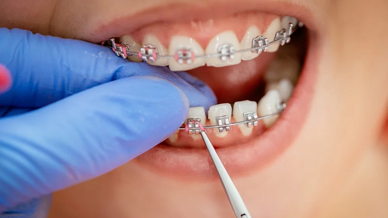 مراحل ارتودنسی دندان | بهترین دندانپزشک اصفهان