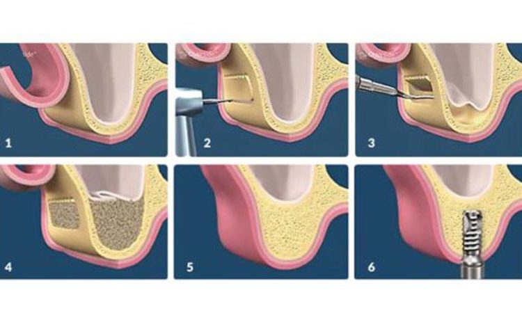 Comparison of open and closed sinus lift operation | The best dentist in Isfahan