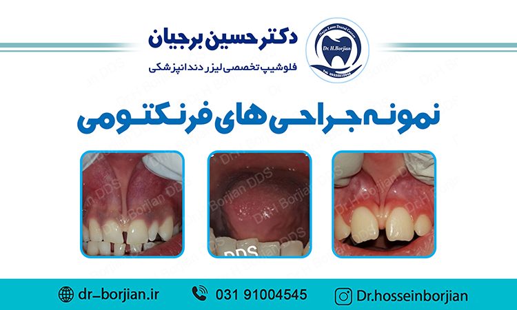 نمونه جراحی های فرنکتومی | بهترین دندانپزشک اصفهان