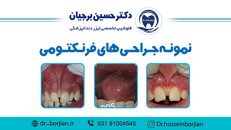 نمونه جراحی های فرنکتومی | بهترین دندانپزشک اصفهان