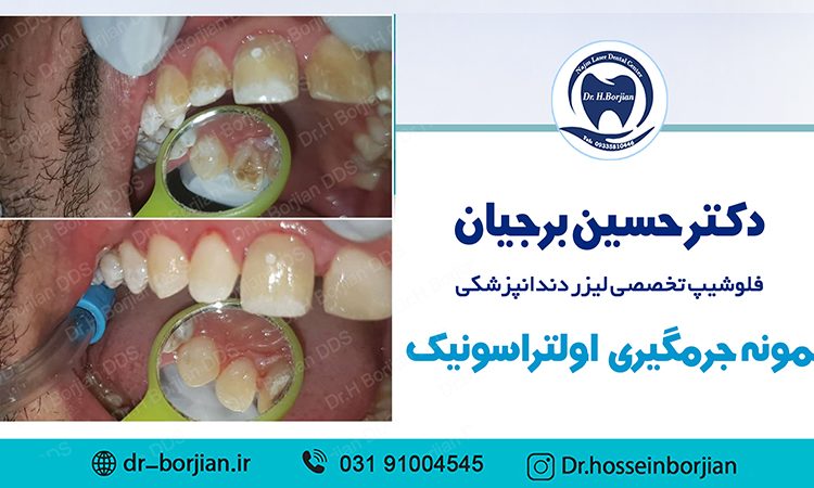 نمونه جرمگیری زیر لثه ای با لیزر (8)| بهترین دندانپزشک اصفهان