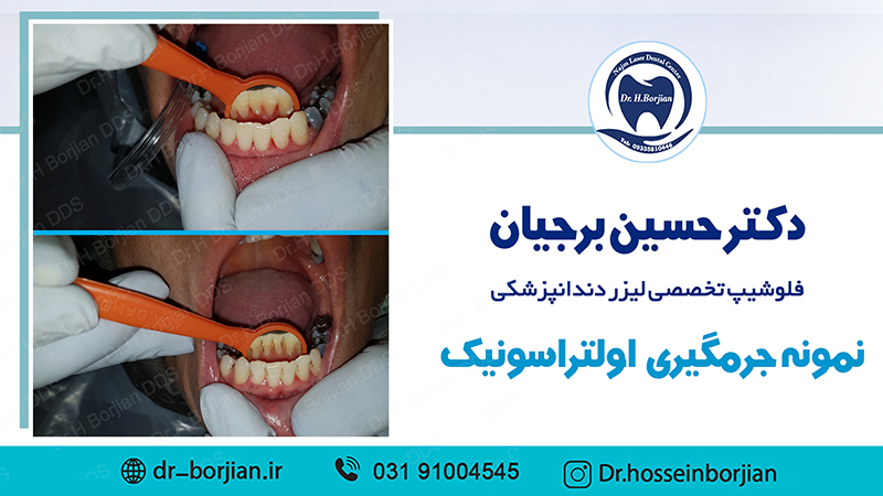 نمونه جرمگیری زیرلثه ای با لیزر(9) | بهترین دندانپزشک اصفهان