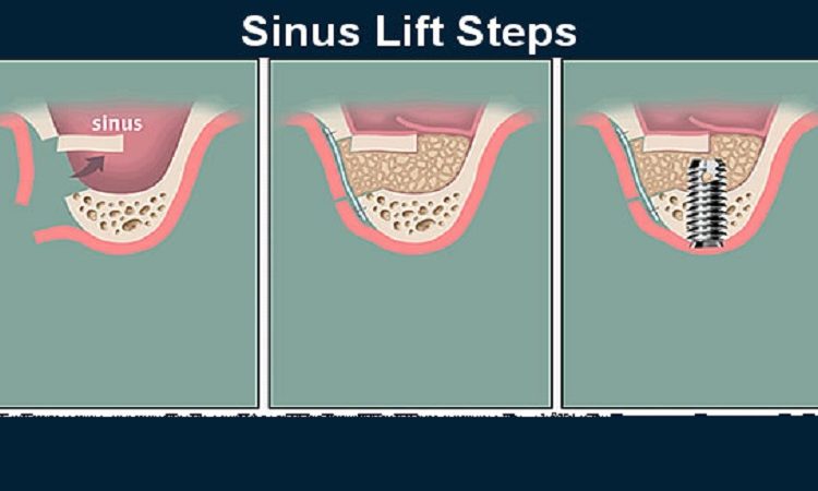 Care tips after gum lift surgery | The best dentist in Isfahan