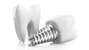 Care tips after dental implant surgery | The best gum surgeon in Isfahan