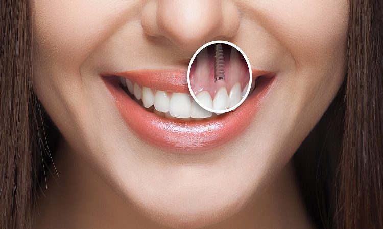 The cost of implant implantation | The best gum surgeon in Isfahan