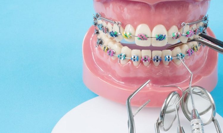 Various devices for orthodontics | The best implant in Isfahan