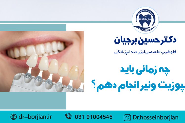 چه زمانی باید کامپوزیت ونیر انجام دهم؟|بهترین دندانپزشک اصفهان