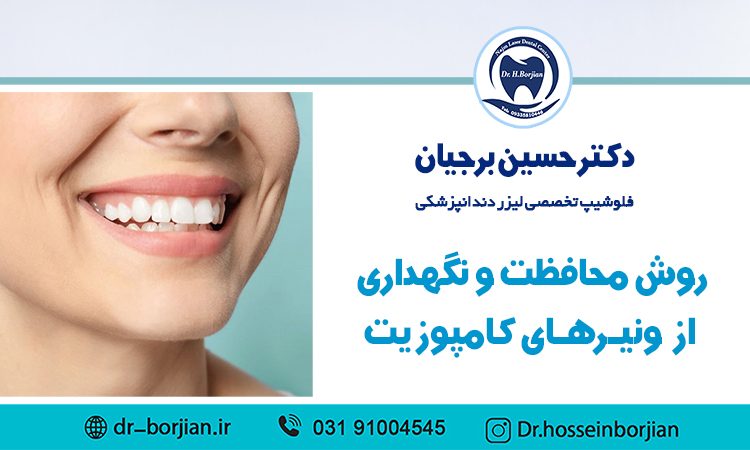 روش محافظت و نگهداری از ونیرهای کامپوزیت|بهترین دندانپزشک اصفهان