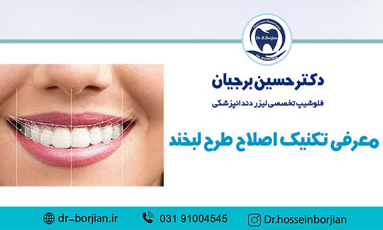 معرفی تکنیک اصلاح طرح لبخند|بهترین دندانپزشک اصفهان