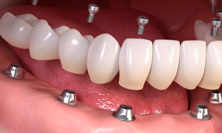التعرف على زراعة الأسنان القصيرة | افضل دكتور اسنان في اصفهان