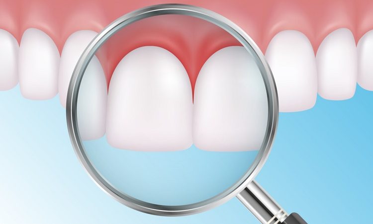 Treatment of gum diseases with gum flap surgery | The best cosmetic dentist in Isfahan