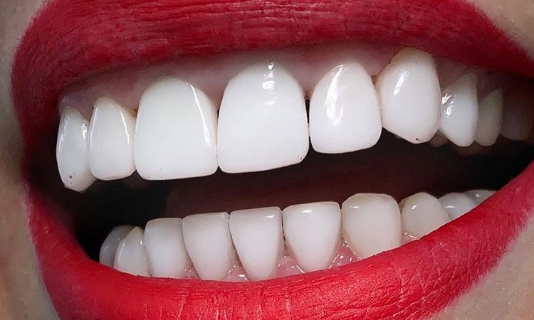 أسباب تغيير شرائح الأسنان | افضل دكتور اسنان تجميلي في اصفهان