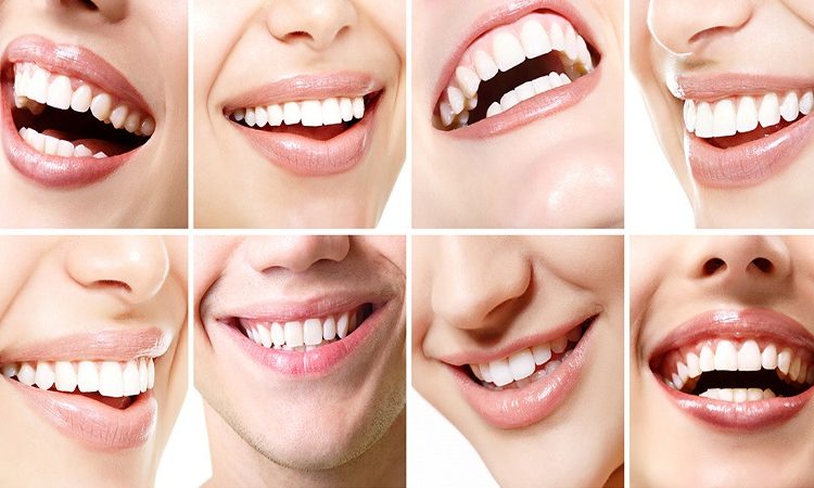 Conditions of not doing internal bleaching | The best cosmetic dentist in Isfahan