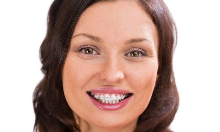 Reasons for using dental braces | The best cosmetic dentist in Isfahan