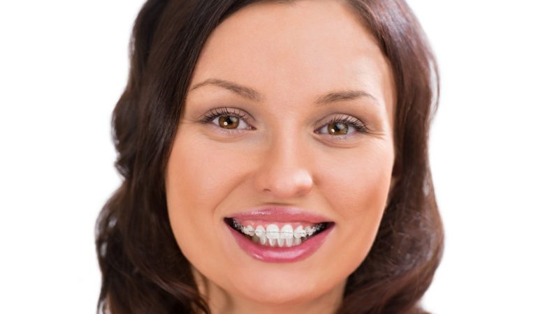 علل استفاده از بریس دندان | بهترین دندانپزشک زیبایی اصفهان