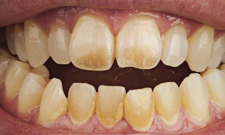 Quelles sont les causes de l'érosion de l'émail dentaire ? | Le meilleur chirurgien des gencives à Ispahan