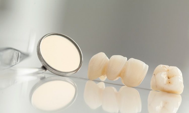 Causes d'infection dans les facettes dentaires | Le meilleur dentiste cosmétique à Ispahan