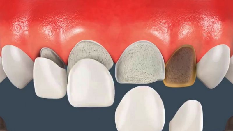 موارد نیاز به برداشتن کامپوزیت دندان | بهترین دندانپزشک اصفهان