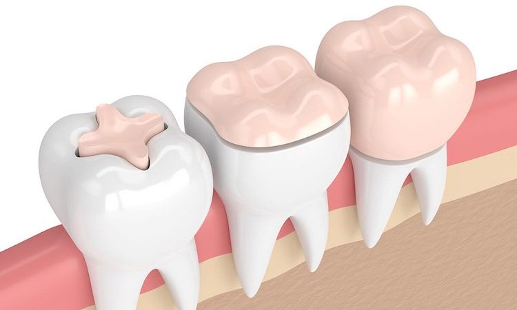 كيفية عمل الفينير للعاملين في طب الأسنان | افضل دكتور اسنان في اصفهان