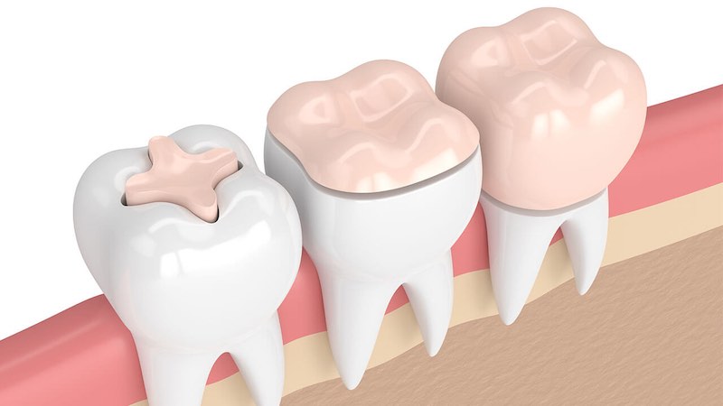 نحوه انجام روکش‌های پرسنل دندان‌ | بهترین دندانپزشک اصفهان